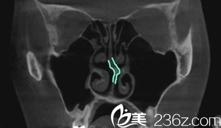 N Plus醫(yī)院鼻部CT檢測圖