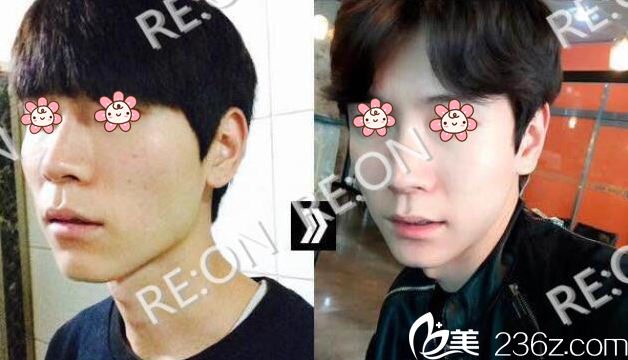 面部輪廓案例1 面部輪廓案例1