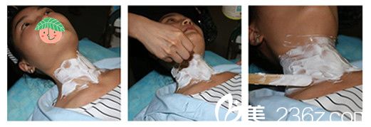 合肥華美王榮堂給我做黃金微針去頸紋敷麻藥膏過(guò)程圖