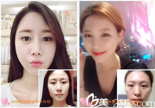 愛琳整形醫(yī)院面部輪廓案例 愛琳整形醫(yī)院面部輪廓案例