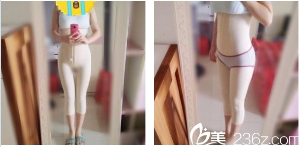 去深圳美萊做完抽脂第二天在家