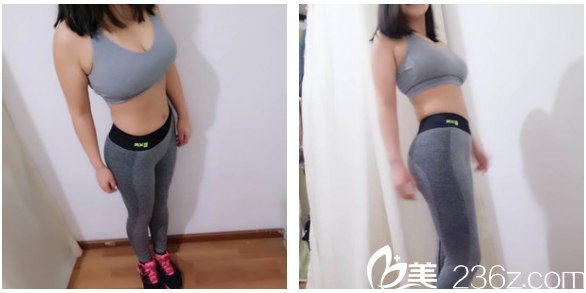 又去深圳美萊做了臀線提升4個月了