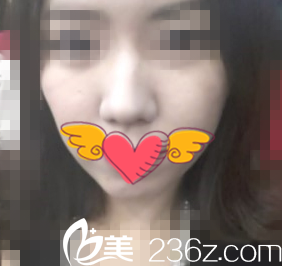 手術(shù)前的樣子 手術(shù)前的樣子