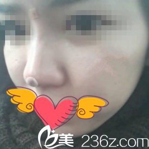 注射隆鼻手術(shù)當(dāng)天 注射隆鼻手術(shù)當(dāng)天