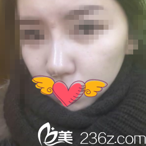 鼻整形術(shù)后半個(gè)小時(shí) 鼻整形術(shù)后半個(gè)小時(shí)