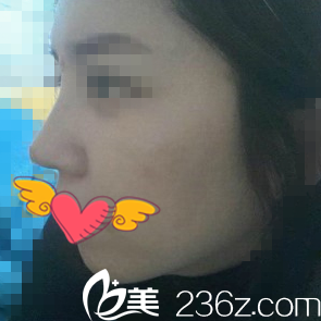 注射隆鼻后出院在地鐵上 注射隆鼻后出院在地鐵上