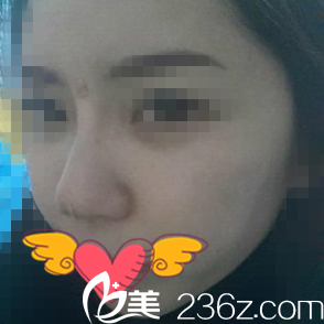 晚上鼻子消腫后的樣子 晚上鼻子消腫后的樣子