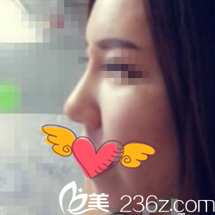 誰說玻尿酸隆鼻效果不好，我在韓國ARTLINE整形醫(yī)院打了1ml玻尿酸后鼻子又挺又自然！