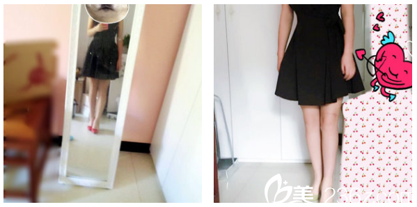 深圳美萊郭杰醫(yī)生腰腹部和大腿抽脂2個月自拍