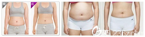 楊建華主任埋線減肥案例