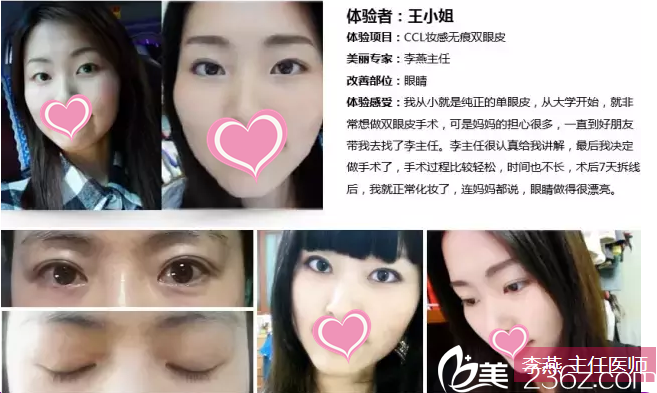 李燕主任雙眼皮案例