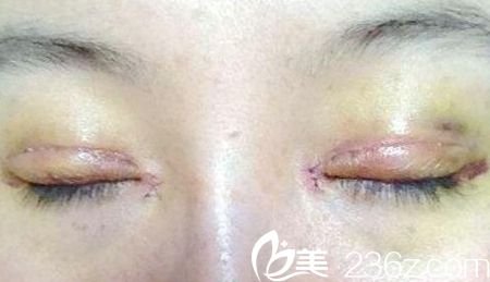 雙眼皮術(shù)后一周照片 雙眼皮術(shù)后一周照片