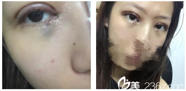 深圳軍科劉月更雙眼皮第5天