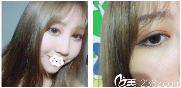 老媽看了深圳軍科整形醫(yī)院劉月更給我做的不開刀雙眼皮后贊不絕口