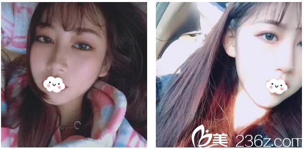 劉月更做的DD數(shù)碼雙眼皮1個月效果圖