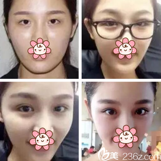 崔恒碩院長(zhǎng)眼修復(fù)案例