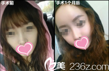 面部自體脂肪填充效果前后對比 面部自體脂肪填充效果前后對比