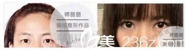 師麗麗醫(yī)生雙眼皮案例效果