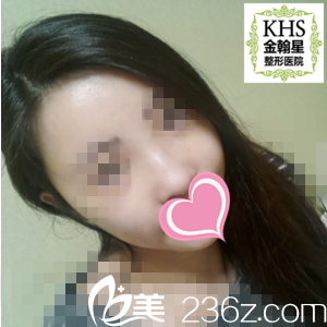 面部脂肪填充術(shù)后2周情況