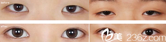 <!--<i data=20240703-sp></i>-->雙眼皮整形怎么樣？雙眼皮整形