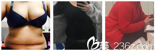 勞波兒整形醫(yī)院真人案例 勞波兒整形醫(yī)院真人案例