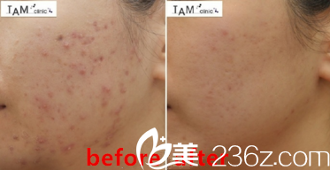 祛痘真人前后效果對比
