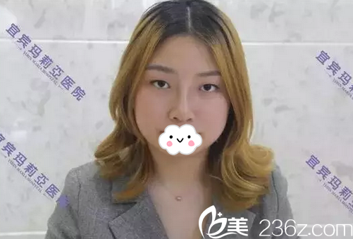 分享宜賓瑪莉亞內(nèi)部員工鼻綜合術(shù)后對比圖 見證女神的誕生