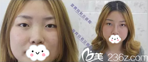 宜賓瑪莉亞整形醫(yī)院鼻綜合術(shù)后正面對比 宜賓瑪莉亞整形醫(yī)院鼻綜合術(shù)后正面對比