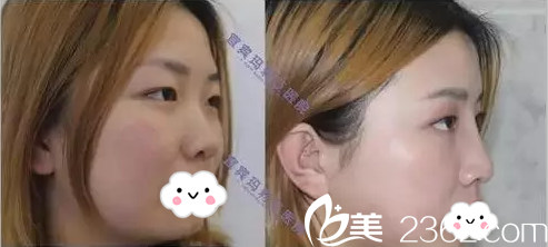 宜賓瑪莉亞整形醫(yī)院鼻綜合術(shù)后側(cè)面對比 宜賓瑪莉亞整形醫(yī)院鼻綜合術(shù)后側(cè)面對比