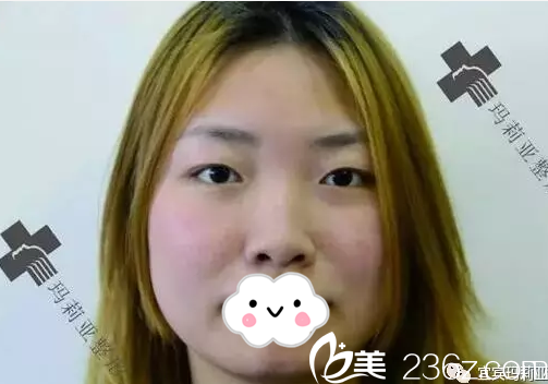 鼻綜合術(shù)前塌鼻梁圓鼻頭 鼻綜合術(shù)前塌鼻梁圓鼻頭