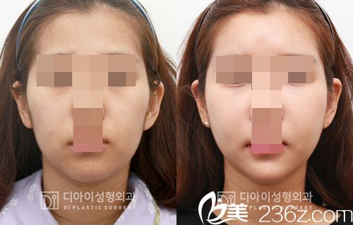 DI整形醫(yī)院面部輪廓案例 DI整形醫(yī)院面部輪廓案例