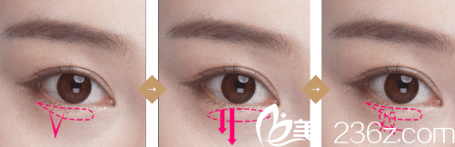 DI整形醫(yī)院雙眼皮示意圖 DI整形醫(yī)院雙眼皮示意圖