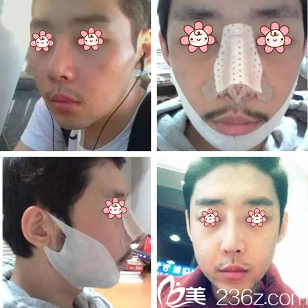 金亨珍院長(zhǎng)面部輪廓加鼻綜合案例