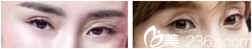 雙眼皮貼造成眼皮多層折痕 雙眼皮貼造成眼皮多層折痕