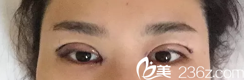 術后即刻效果圖 術后即刻效果圖