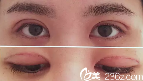 術后一周拆線效果圖 術后一周拆線效果圖