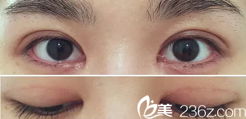 術后兩個月效果圖 術后兩個月效果圖