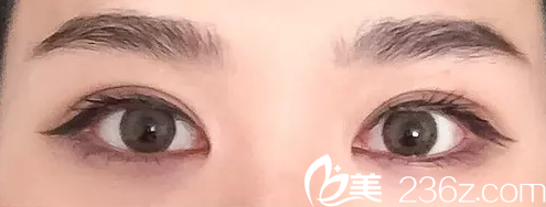 撫順博愛黃紹敏醫(yī)生做的全切雙眼皮 點(diǎn)金手讓我秒變小仙女