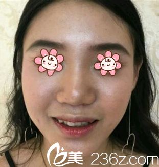 去韓國金亨珍紐萊茵整形外科前的我 去韓國金亨珍紐萊茵整形外科前的我