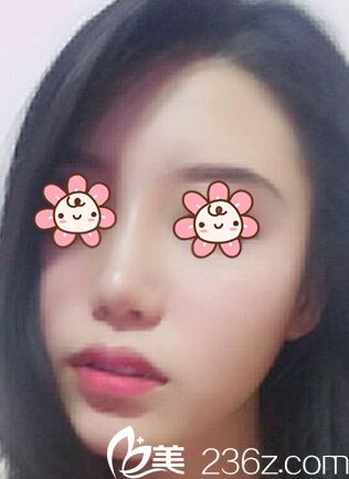 國內(nèi)沒成我就去韓國金亨珍紐萊茵整形做耳軟骨墊鼻尖+假體墊鼻梁咯