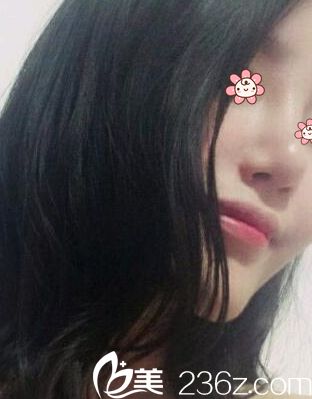 感覺一個(gè)月后鼻子越來越好看~ 感覺一個(gè)月后鼻子越來越好看~