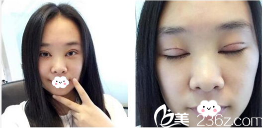 陳磊醫(yī)生做的雙眼皮第3天圖片