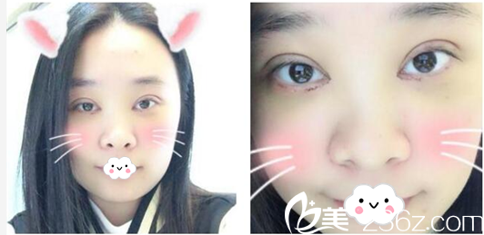 深圳美萊陳磊雙眼皮案例第6天