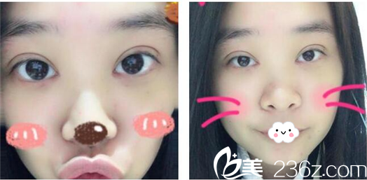 陳磊做的雙眼皮案例第九天效果圖