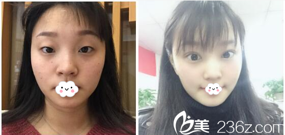 深圳美萊陳磊雙眼皮案例對比圖