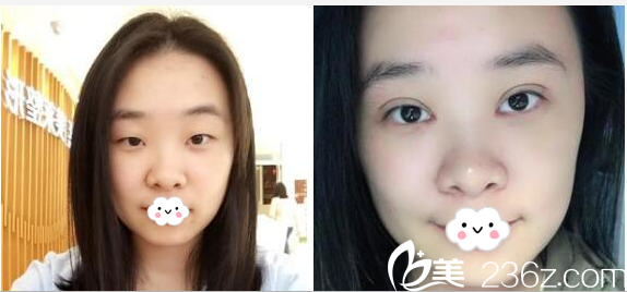 深圳美萊陳磊醫(yī)生做的全切雙眼皮案例