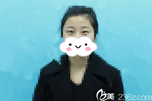 單眼皮的我 單眼皮的我