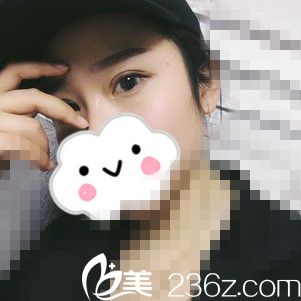 看我在韓國哈娜兒整形外科做的雙眼皮閨蜜們都說贊