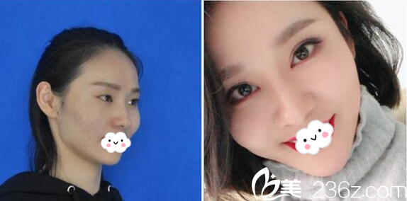 深圳富華整形醫(yī)院屈晶做的雙眼皮案例 深圳富華整形醫(yī)院屈晶做的雙眼皮案例