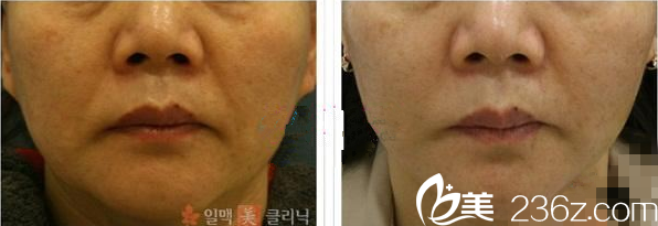 韓國一脈美面部提升去皺手術(shù)